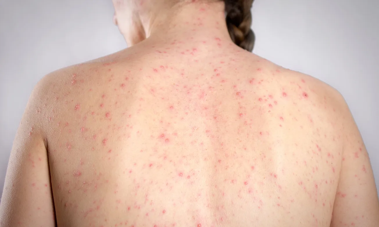 Botched Measles Campaign Cost $1,300 per Person