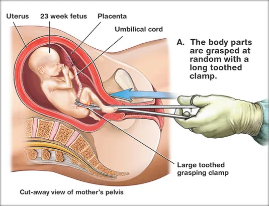 Irish Review Wants to Let Abortion Doctors off the Hook