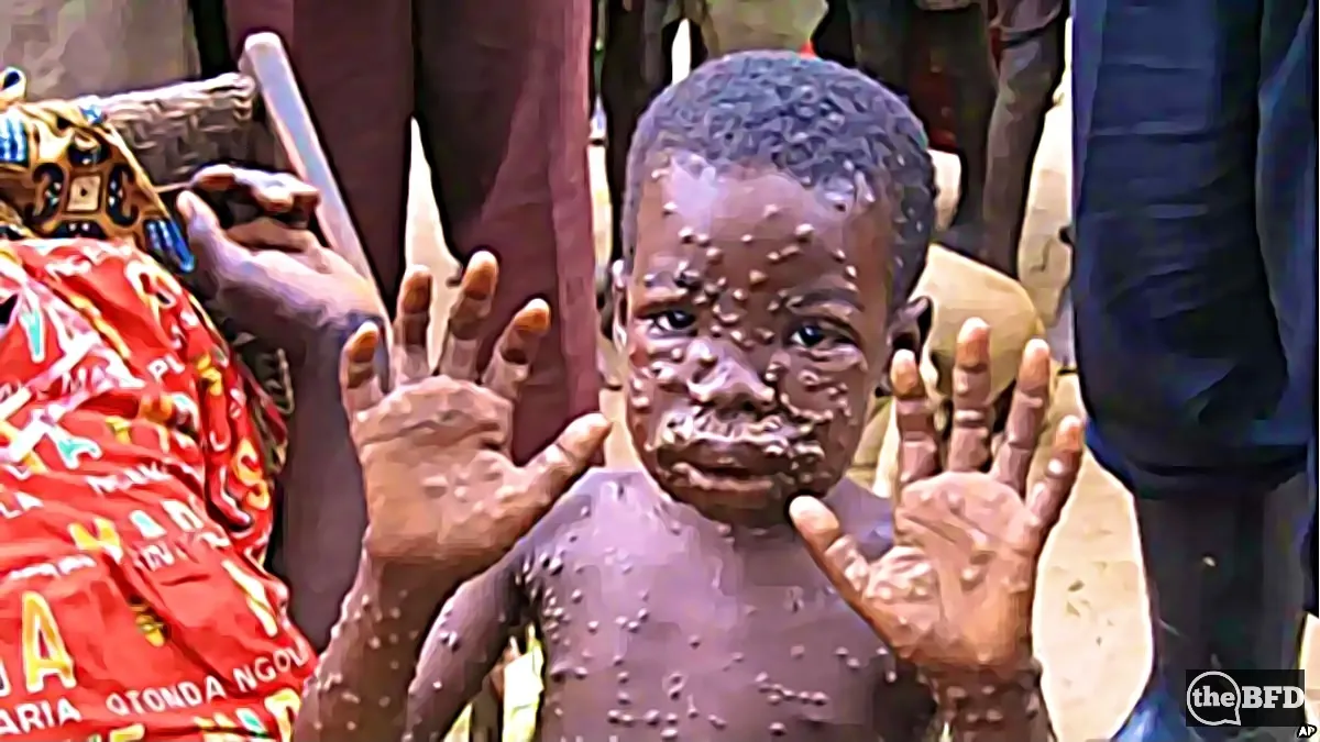 What Is Monkeypox?