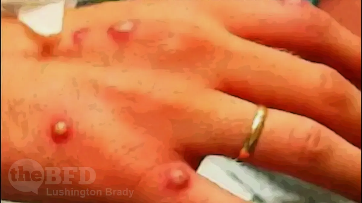 You Can’t Call It ‘Monkeypox’ Any More